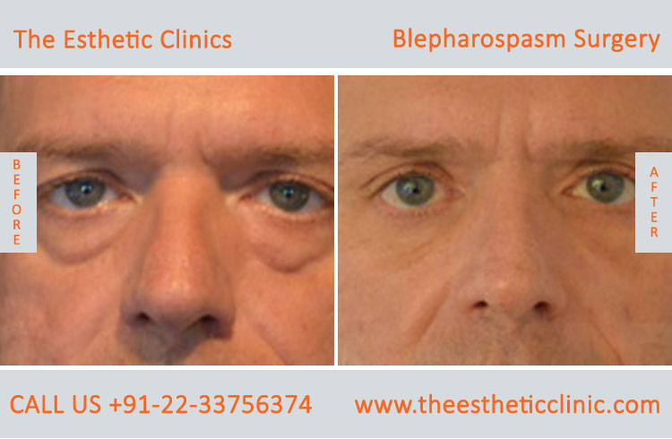 Blepharospasm Treatment, Eyelid Treatment before after photos in mumbai india (4)